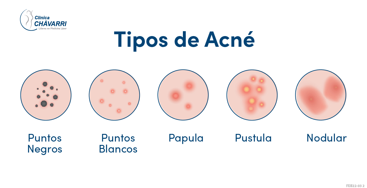 Tipos de espinillas o acne